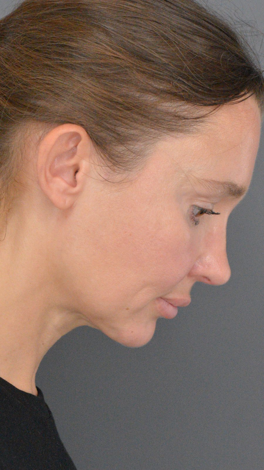 Ponytail Lift after, case 02