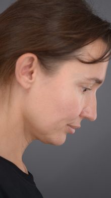 Ponytail Lift before and after, case 02 (before)