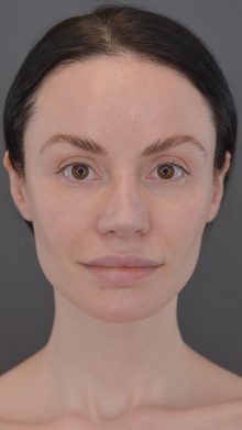 Ponytail Lift before and after, case 03 (after)
