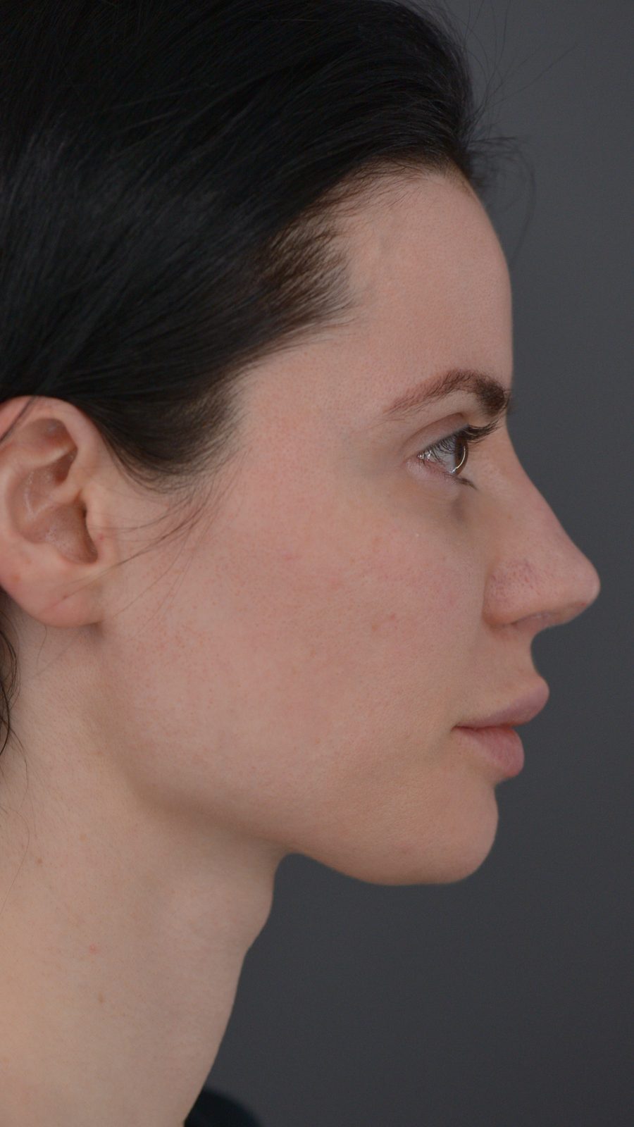 Ponytail Lift before and after, case 03, view 3 (before)