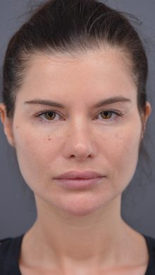 Ponytail Lift before and after, case 04 (before)