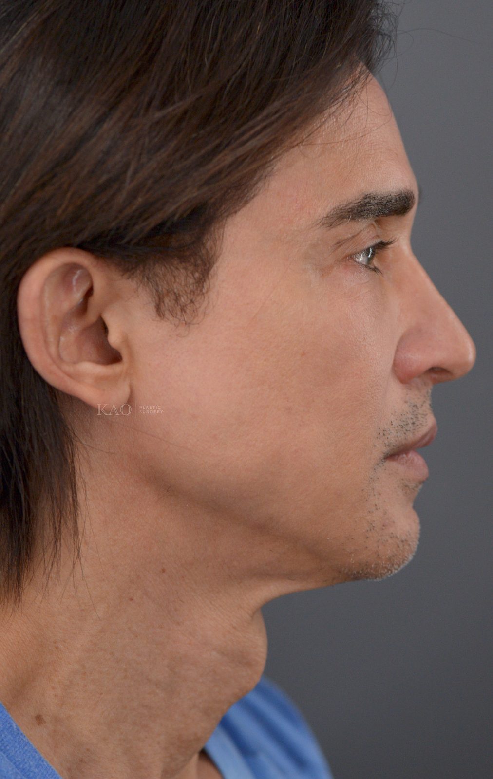Ponytail Lift before and after, case 05, view 3 (before)
