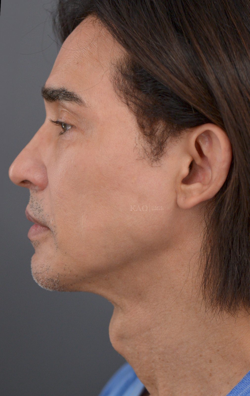 Ponytail Lift before and after, case 05, view 6 (before)