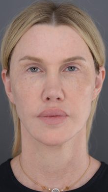 Ponytail Lift before and after, case 06 (before)