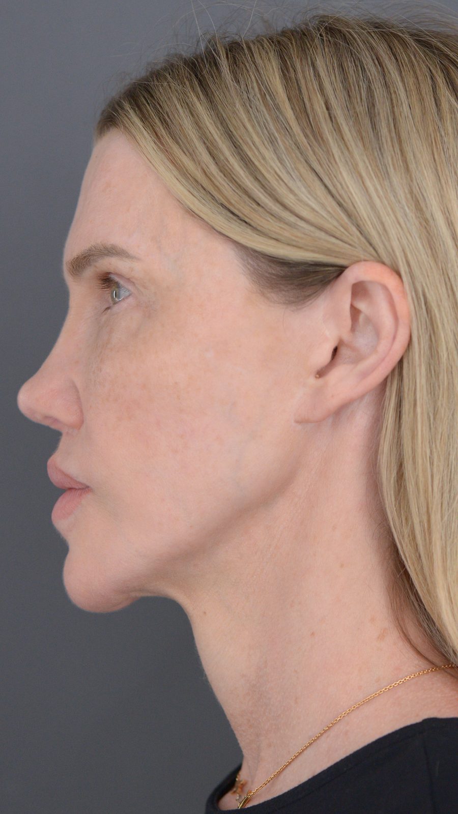 Ponytail Lift before and after, case 06, view 7 (before)