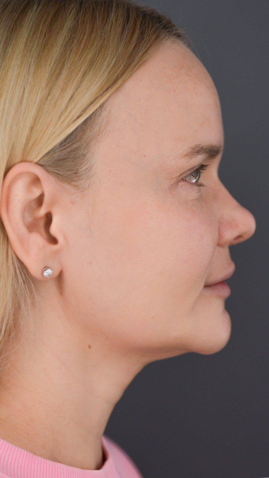 Ponytail Lift before and after, case 07, view 3 (before)