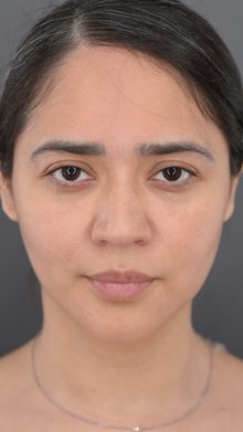 Ponytail Lift before and after, case 08 (before)