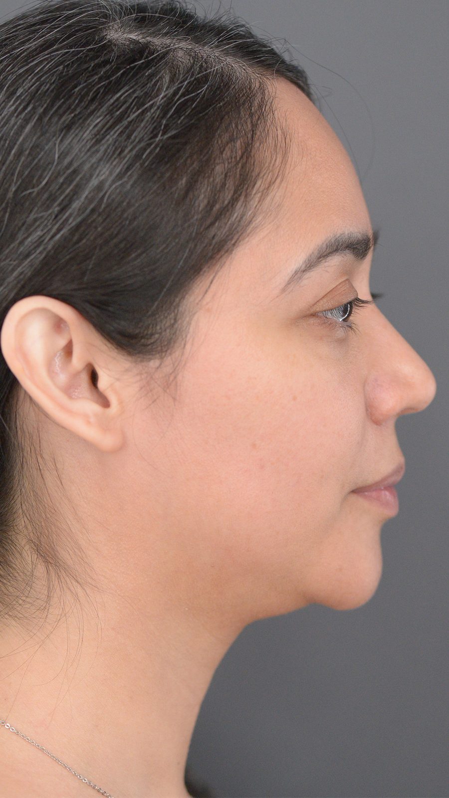 Ponytail Lift before and after, case 08, view 4 (before)