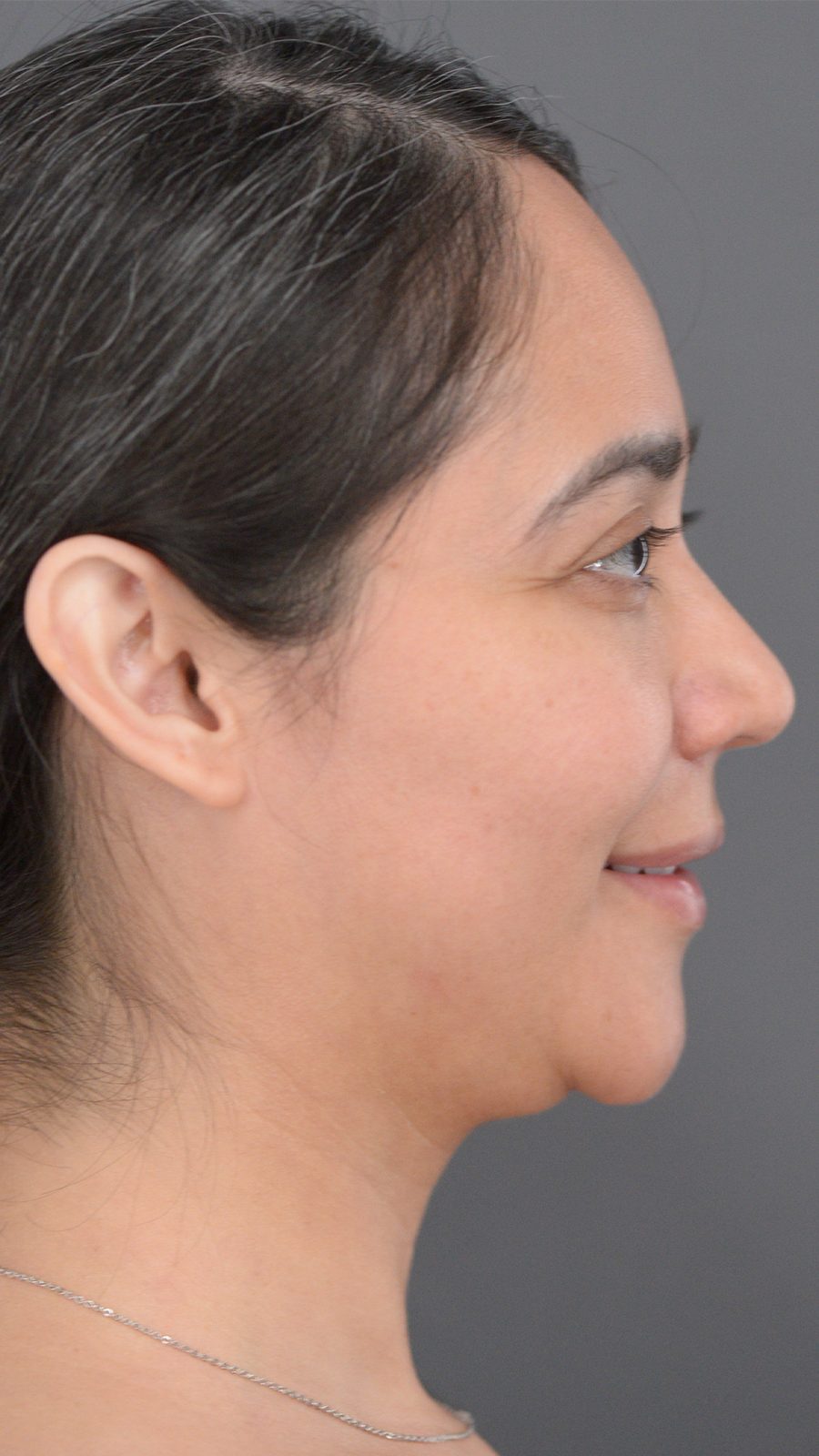 Ponytail Lift before and after, case 08, view 5 (before)
