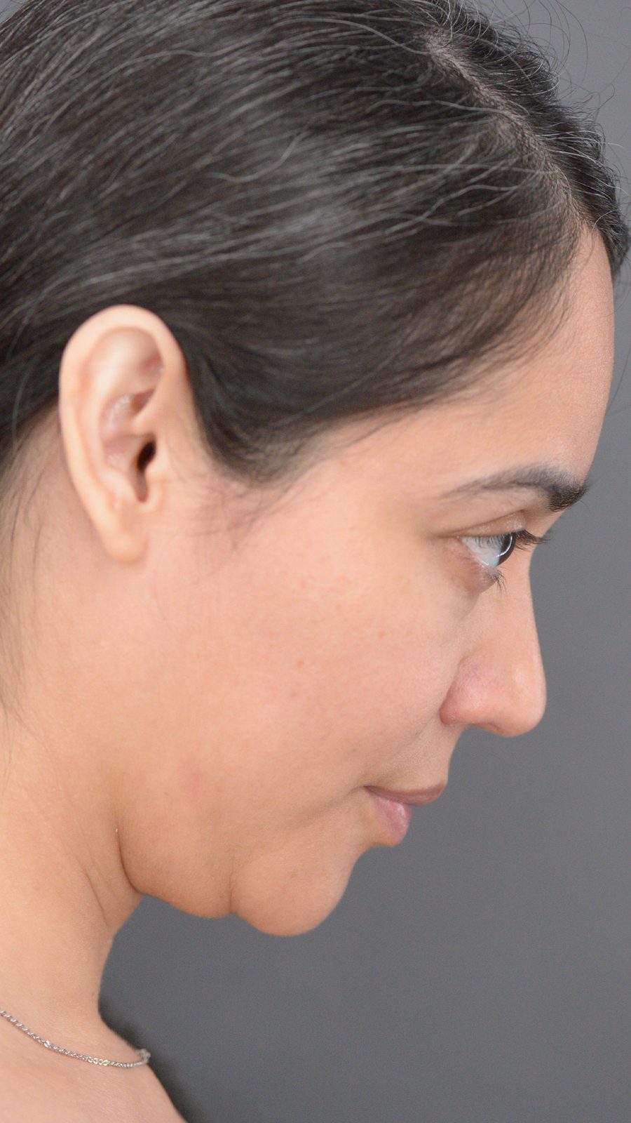 Ponytail Lift before and after, case 08, view 6 (before)