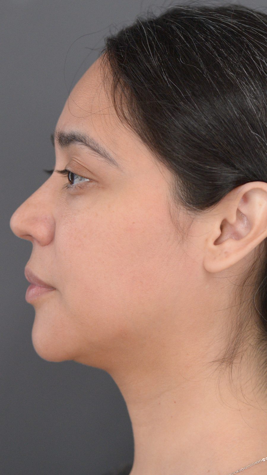 Ponytail Lift before and after, case 08, view 8 (before)