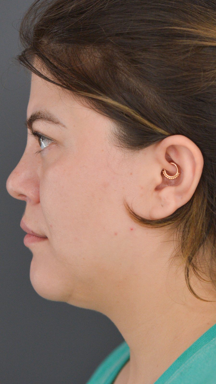 Ponytail Lift before and after, case 09, view 5 (before)