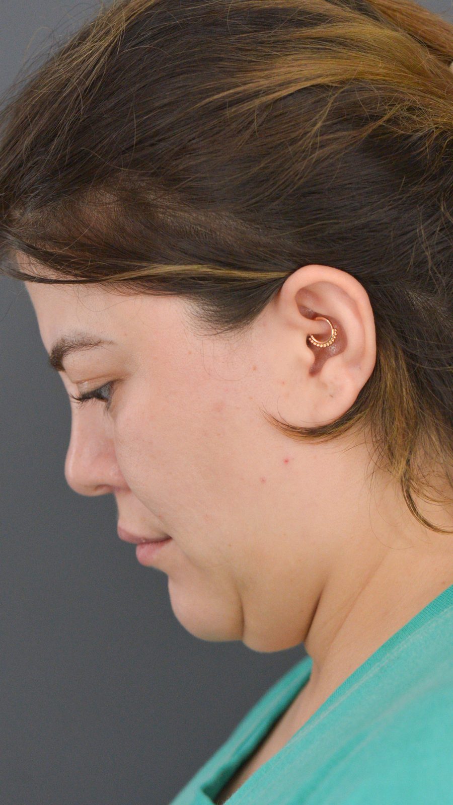 Ponytail Lift before and after, case 09, view 6 (before)