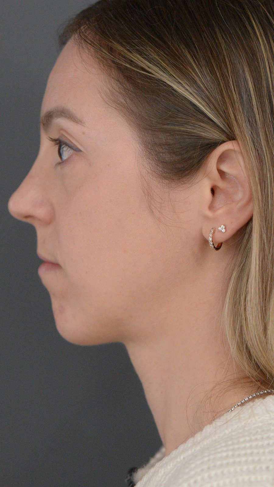 Ponytail Lift before and after, case 10, view 11 (before)