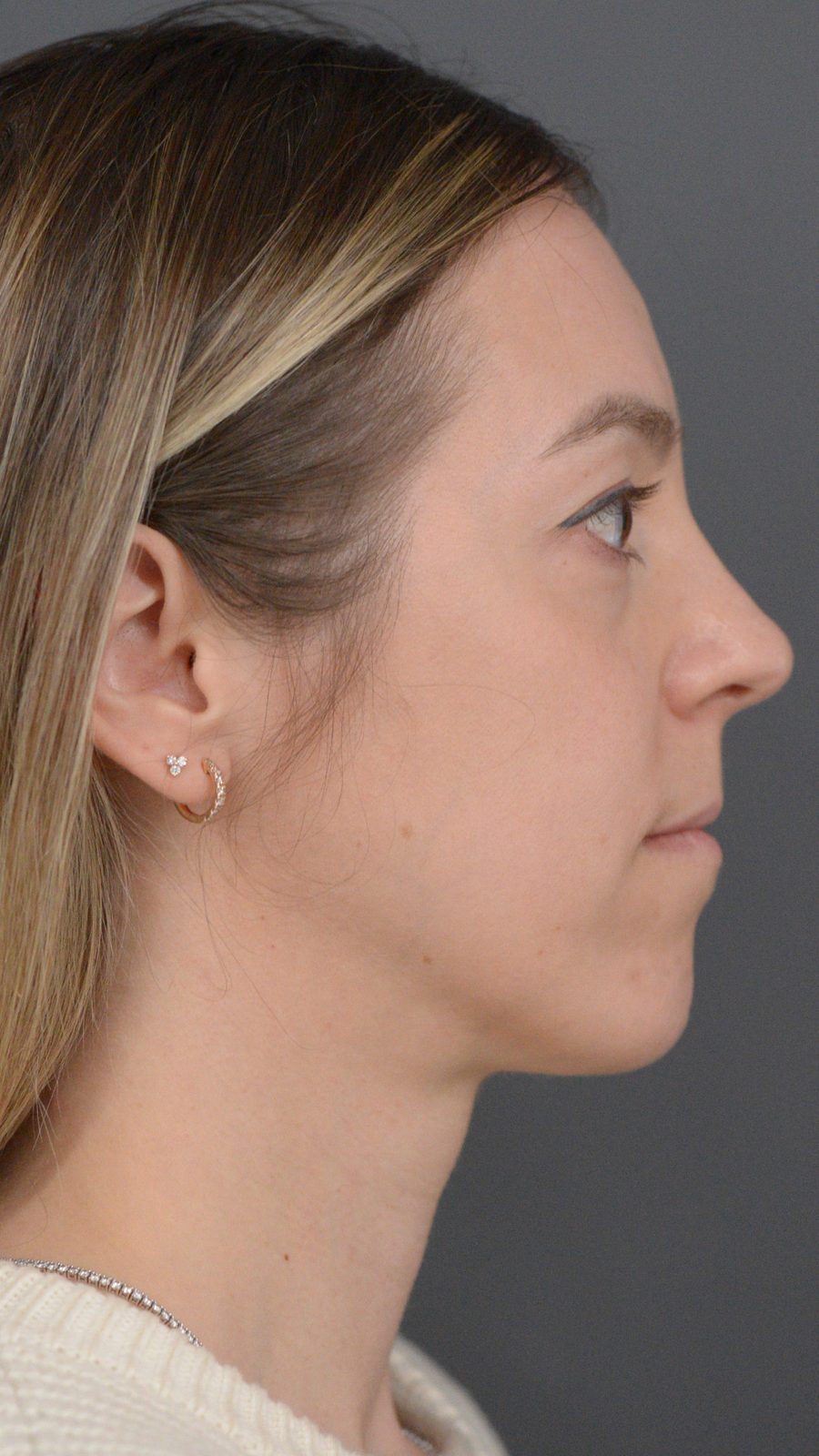 Ponytail Lift before and after, case 10, view 6 (before)