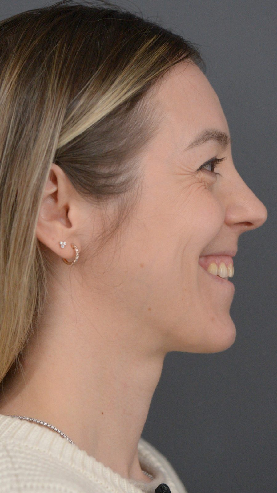 Ponytail Lift before and after, case 10, view 7 (before)