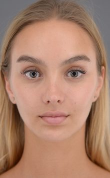 Ponytail Lift before and after, case 11 (after)