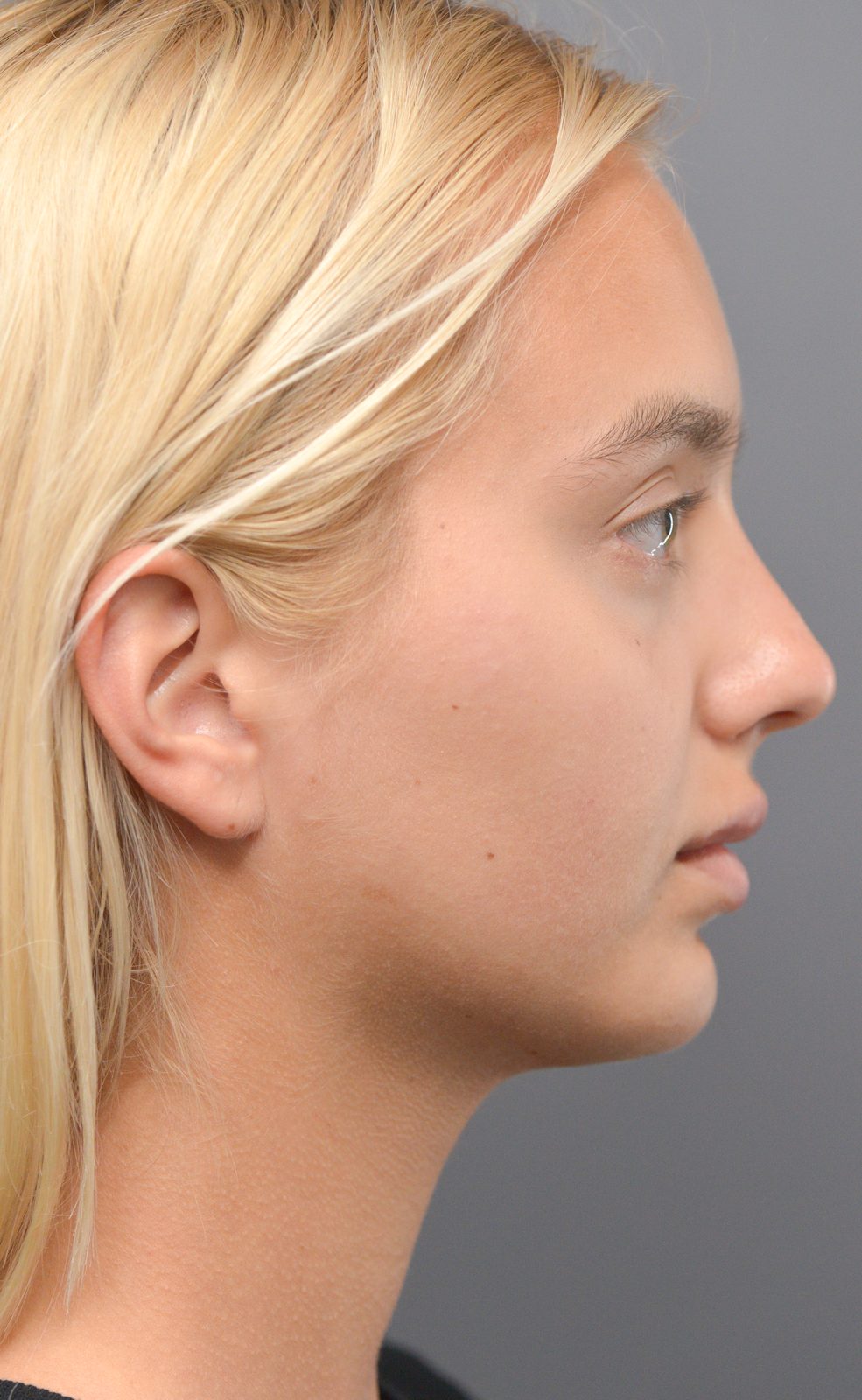 Ponytail Lift before and after, case 11, view 3 (before)