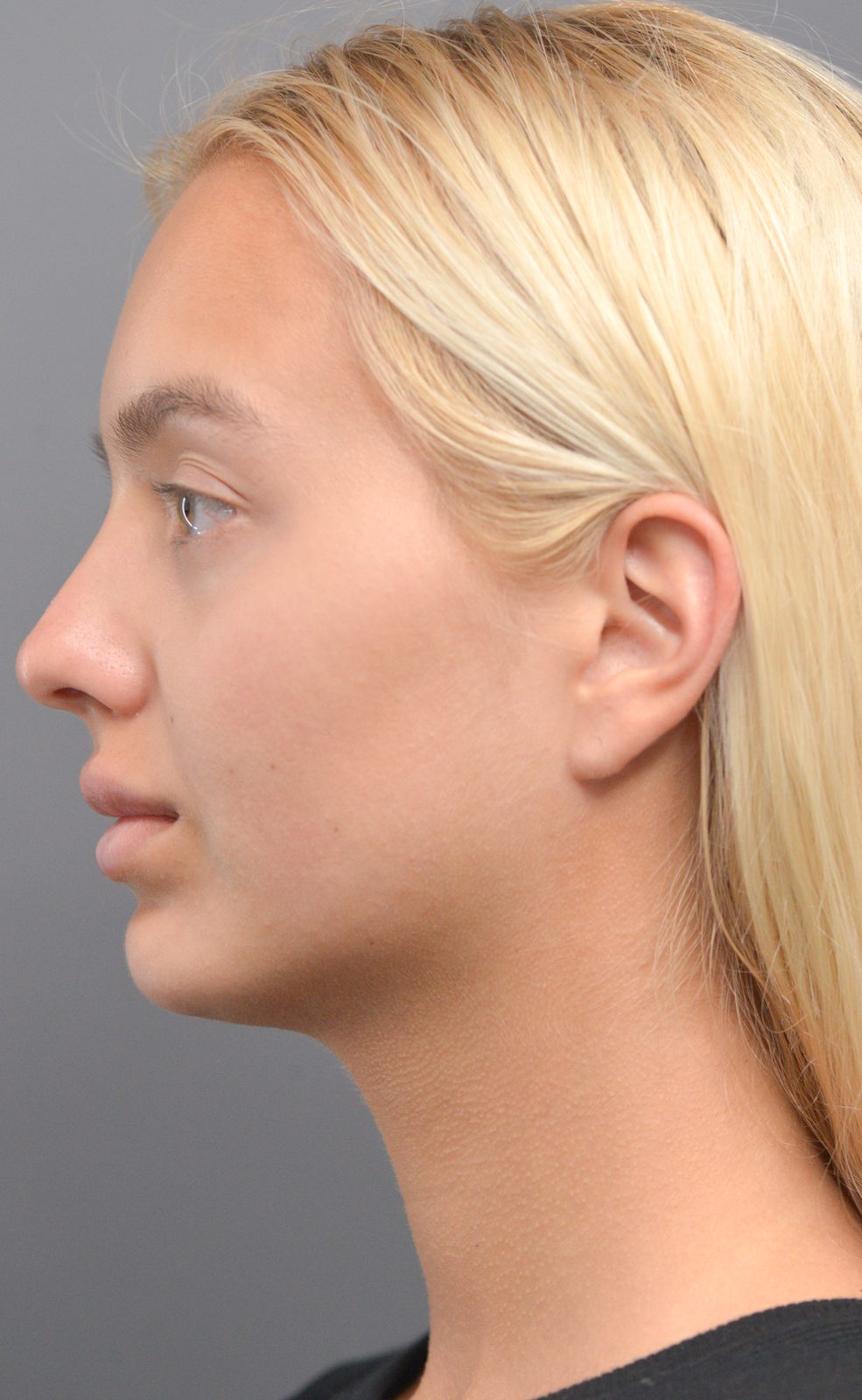Ponytail Lift before and after, case 11, view 6 (before)
