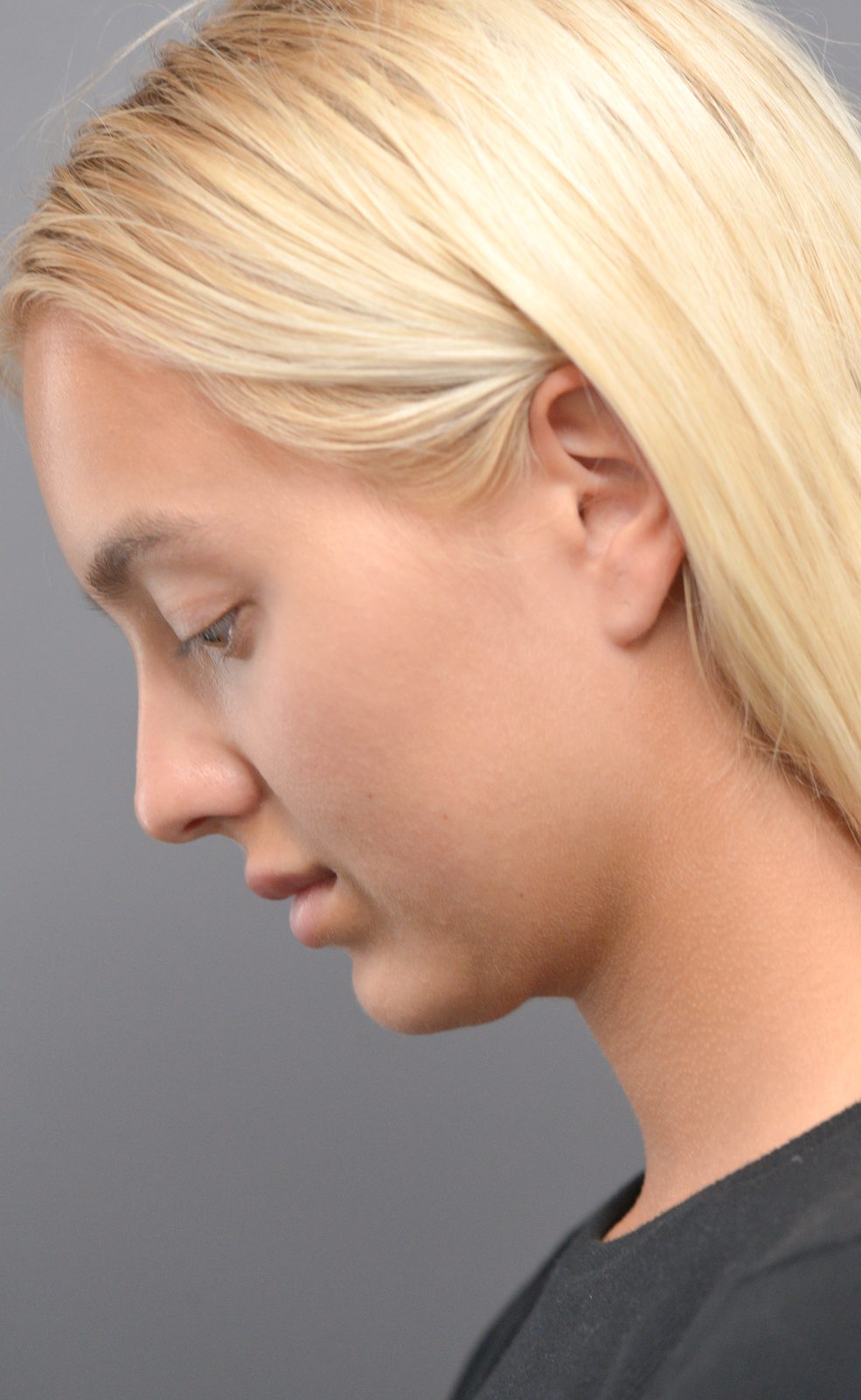 Ponytail Lift before and after, case 11, view 7 (before)