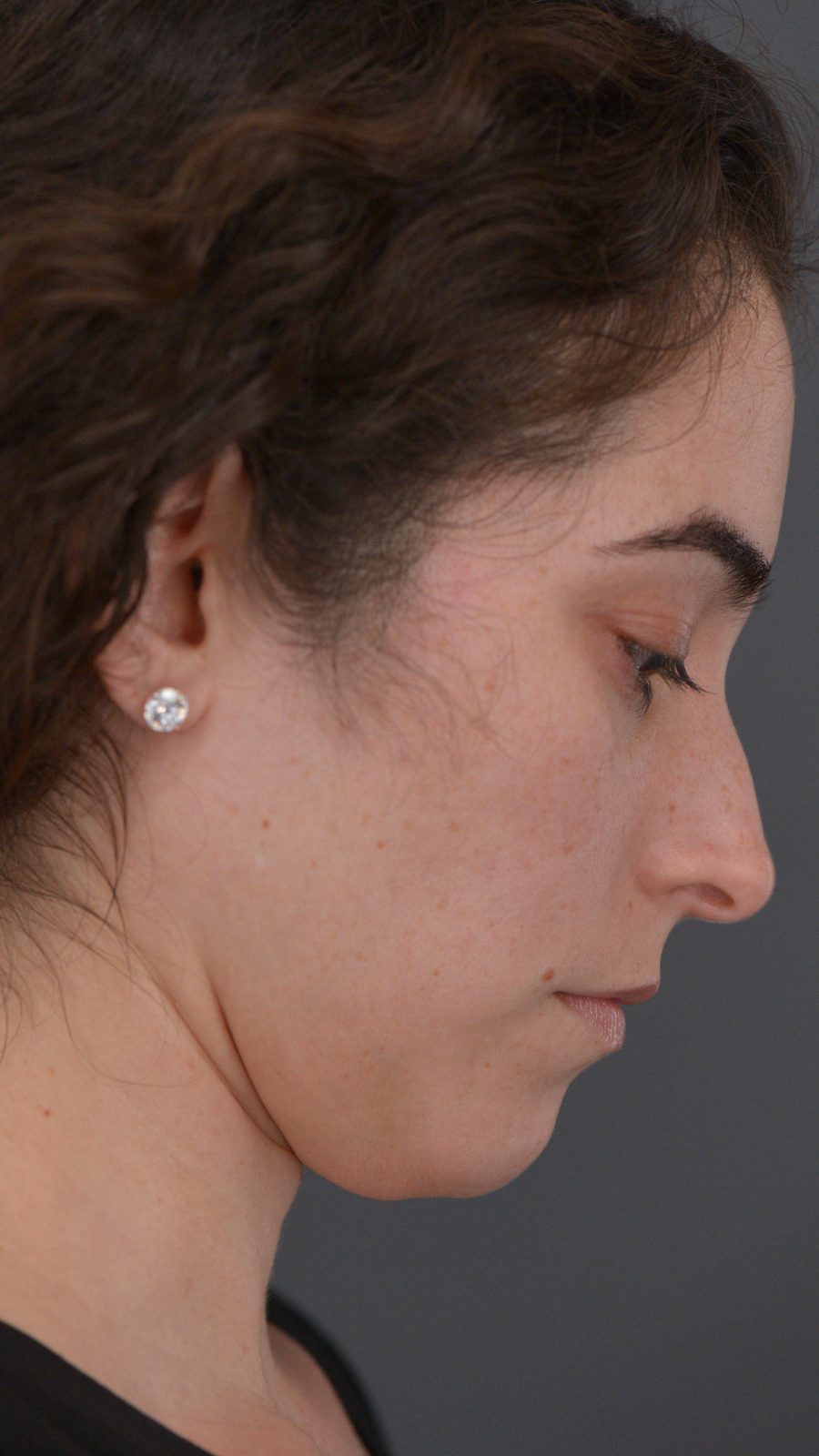 Ponytail Lift before and after, case 13, view 3 (before)