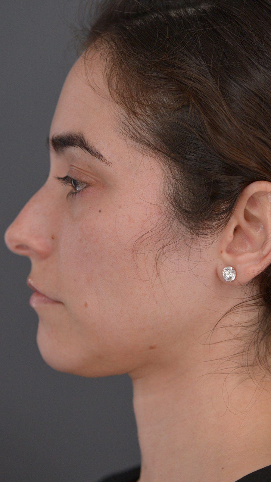 Ponytail Lift before and after, case 13, view 5 (before)