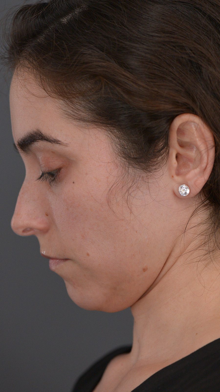 Ponytail Lift before and after, case 13, view 6 (before)