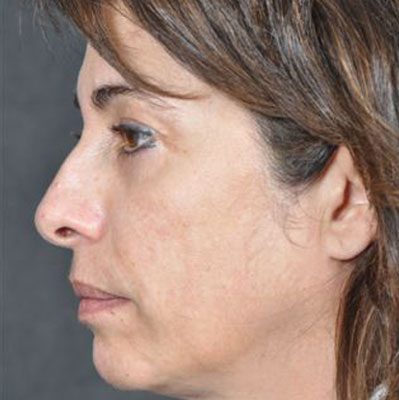 Ponytail Lift before and after, case 15, view 5 (before)