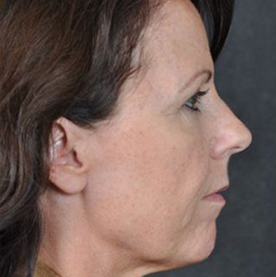 Ponytail Lift before and after, case 17, view 3 (before)