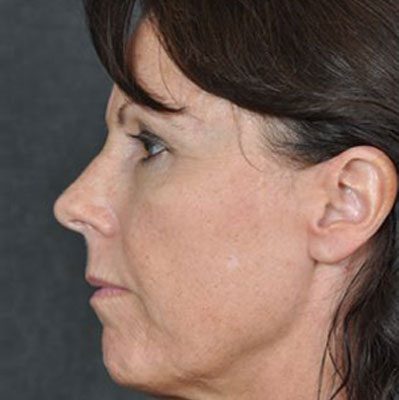 Ponytail Lift before and after, case 17, view 5 (before)
