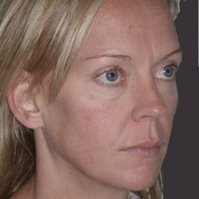 Ponytail Lift before and after, case 19 (before)