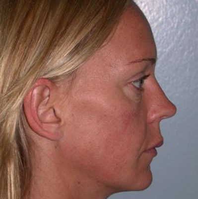 Ponytail Lift before and after, case 19, view 3 (before)