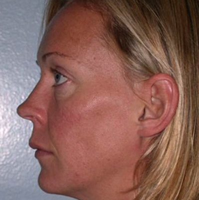 Ponytail Lift before and after, case 19, view 5 (before)