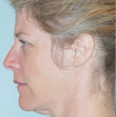 Ponytail Lift before and after, case 20, view 4 (before)
