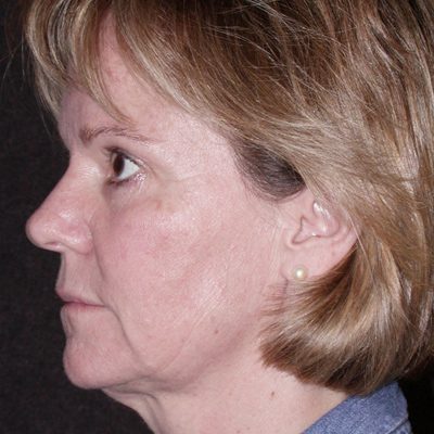 Ponytail Lift before and after, case 21, view 4 (before)