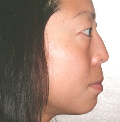 Ponytail Lift before and after, case 22, view 3 (before)