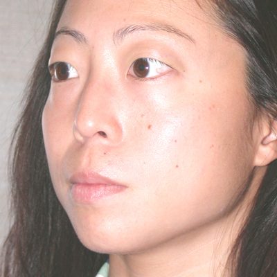 Ponytail Lift before and after, case 22, view 4 (before)