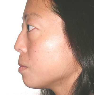 Ponytail Lift before and after, case 22, view 5 (before)