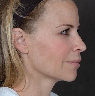 Ponytail Lift before and after, case 23, view 3 (before)