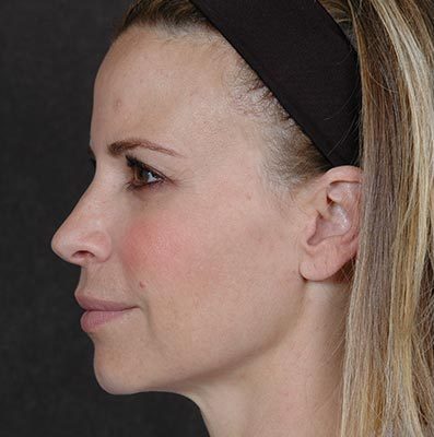 Ponytail Lift before and after, case 23, view 5 (before)