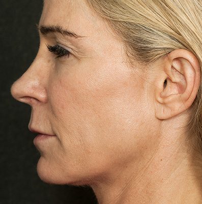 Ponytail Lift before and after, case 24, view 5 (before)