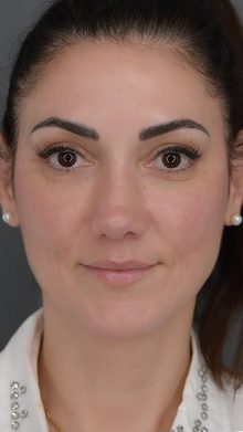 Rhinoplasty before and after, case 01 (after)