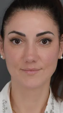 Rhinoplasty, case 01, after