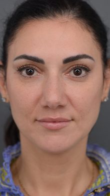 Rhinoplasty before and after, case 01 (before)