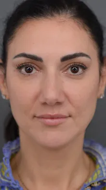Rhinoplasty, case 01, before