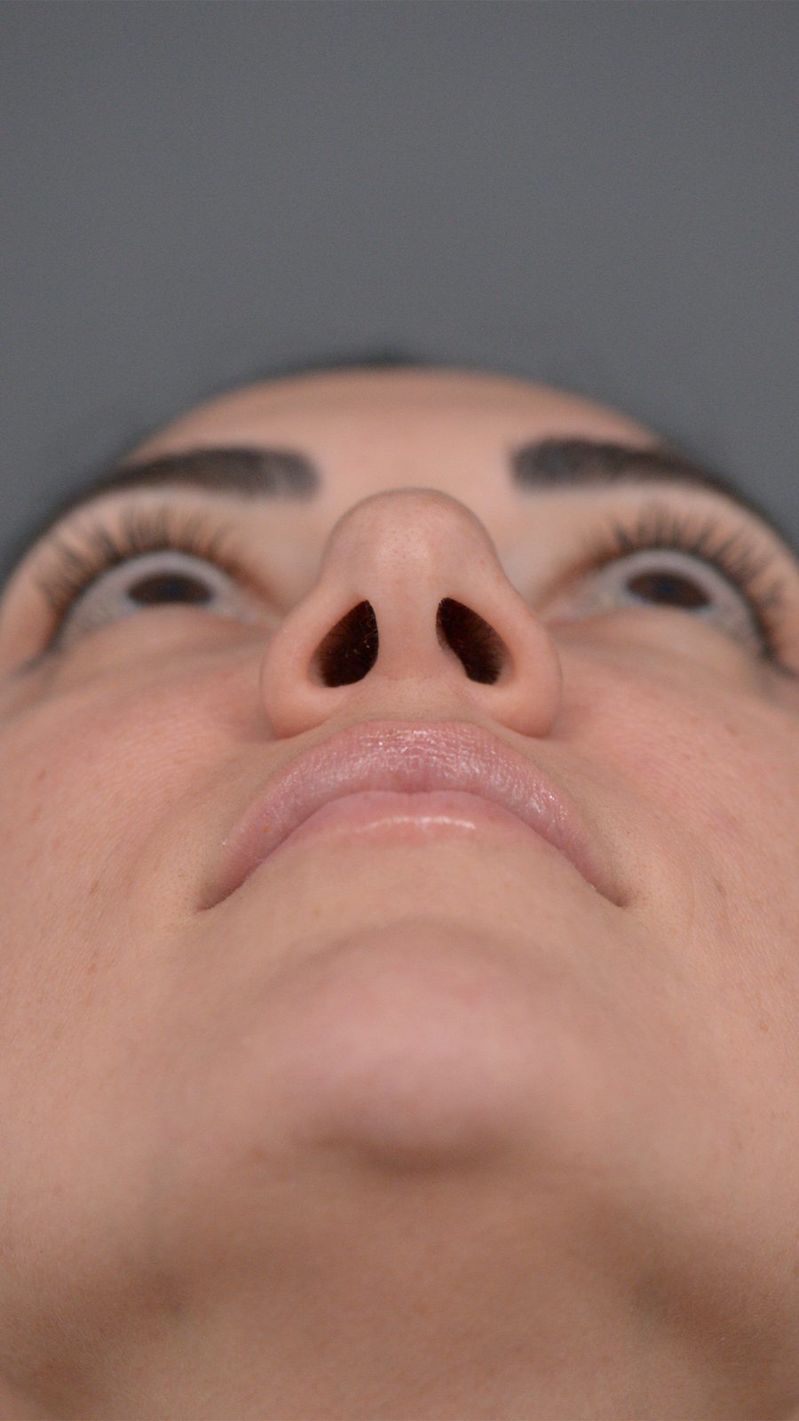 Rhinoplasty before and after, case 01, view 3 (before)