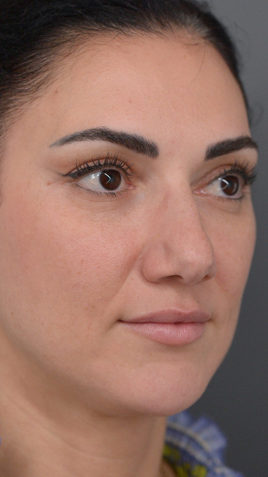 Rhinoplasty before and after, case 01, view 4 (before)