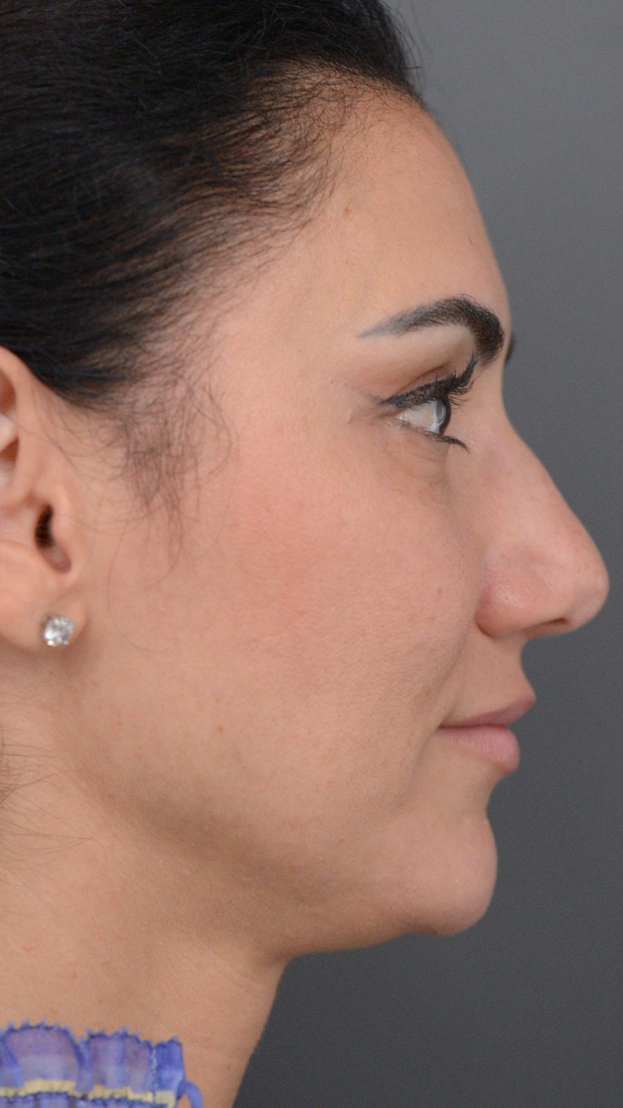 Rhinoplasty before and after, case 01, view 5 (before)