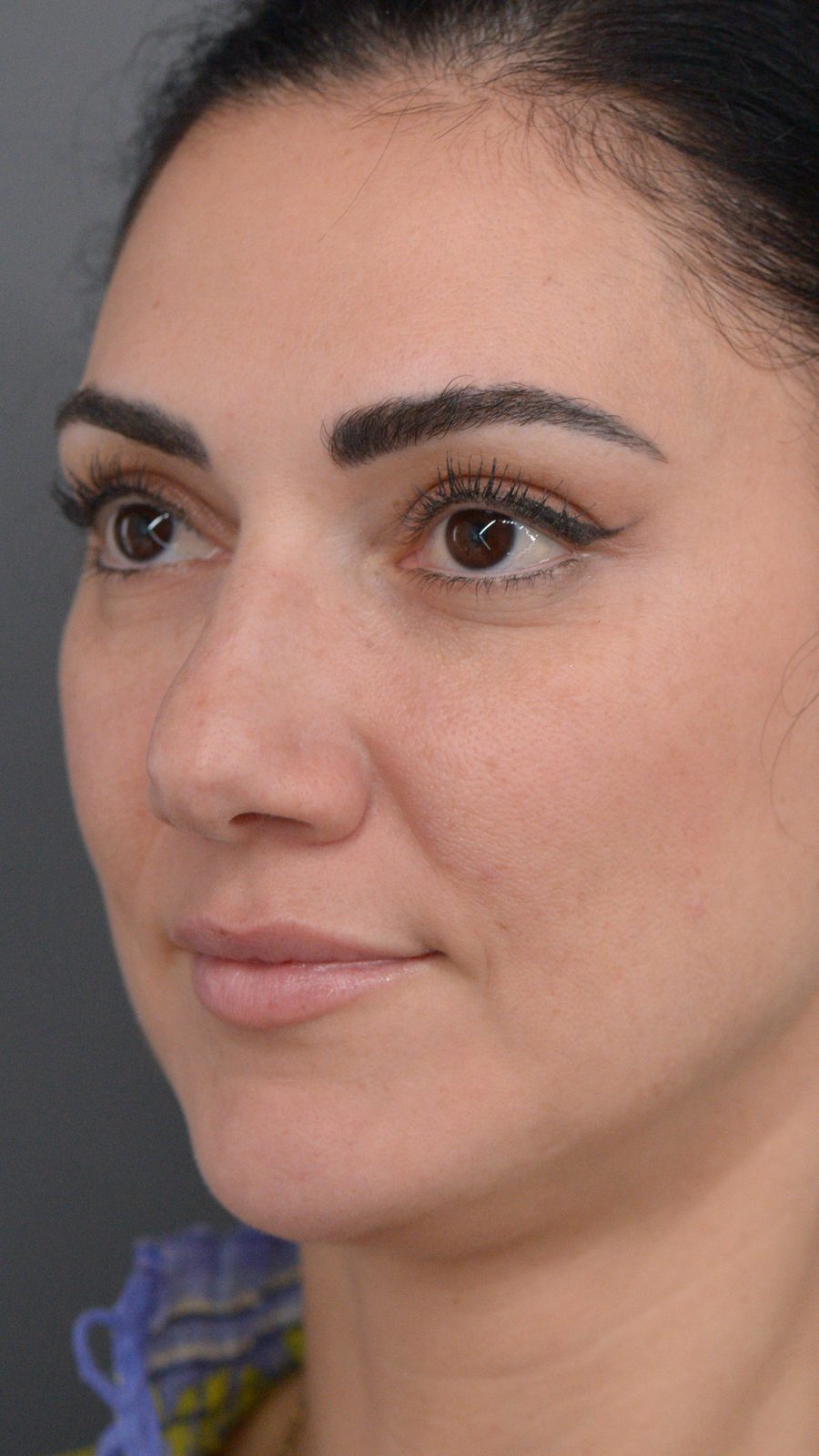 Rhinoplasty before and after, case 01, view 6 (before)