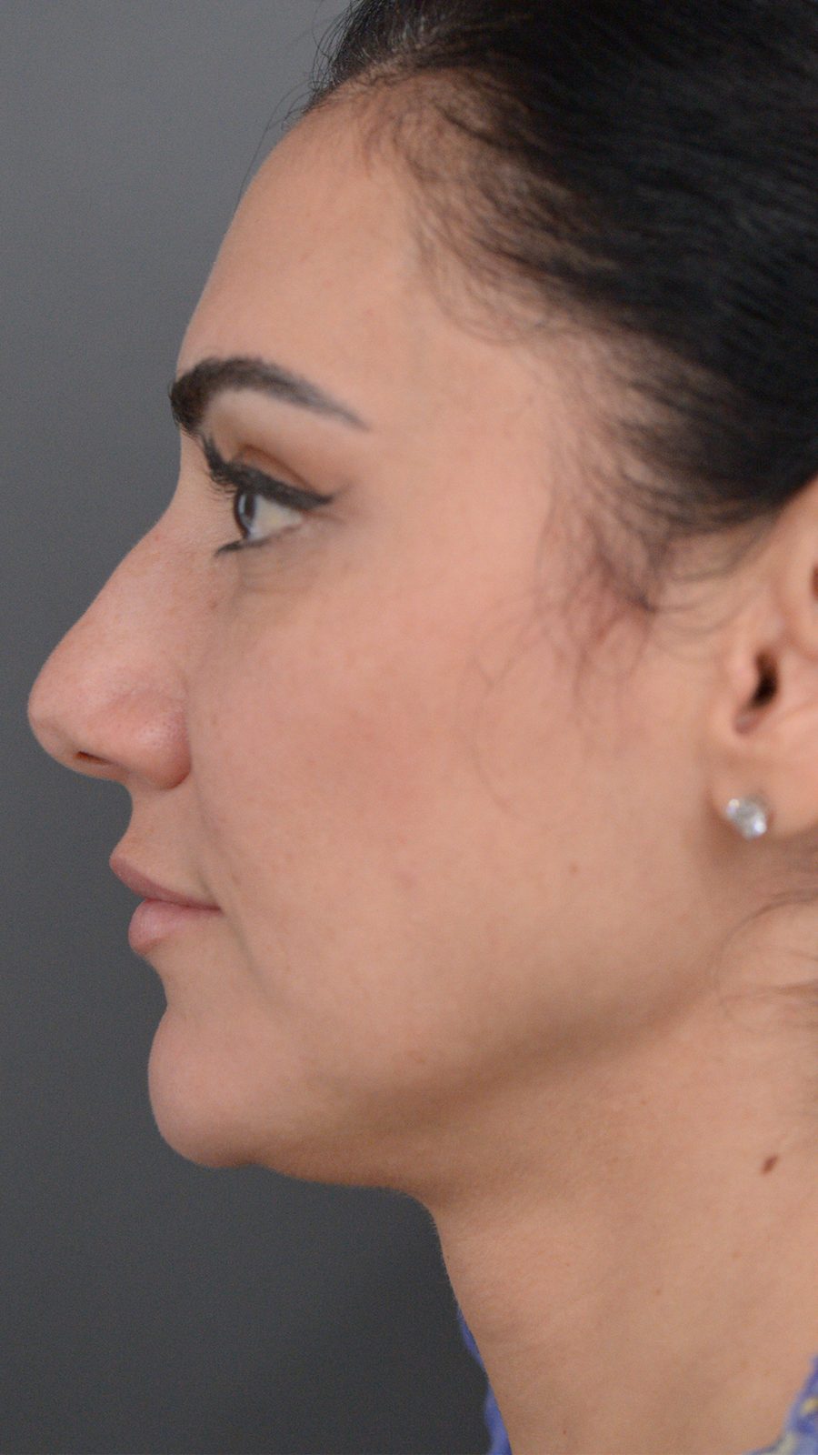 Rhinoplasty before and after, case 01, view 7 (before)